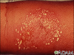 Pustules - superficial on the arm Pustules - superficial on the arm