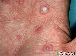Erythema multiforme, target lesions on the palm Erythema multiforme, target lesions on the palm