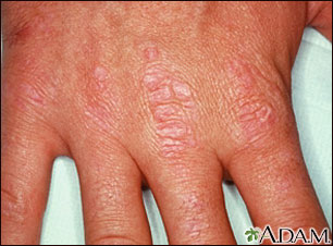 Dermatomyositis - Gottron's papules on the hand Dermatomyositis - Gottron's papules on the hand