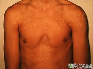 Tinea versicolor - shoulders Tinea versicolor - shoulders