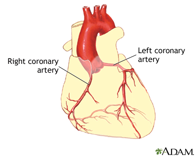 Coronary artery balloon angioplasty - Series Coronary artery balloon angioplasty - Series