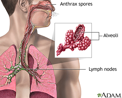 Inhalation Anthrax Inhalation Anthrax