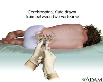 Lumbar puncture (spinal tap) Lumbar puncture (spinal tap)