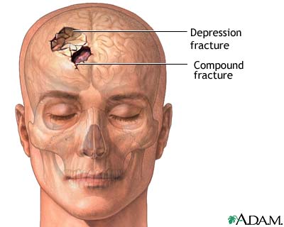 Skull fracture Skull fracture