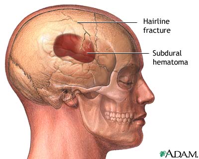 Skull fracture Skull fracture