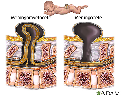Spina bifida (degrees of severity) Spina bifida (degrees of severity)