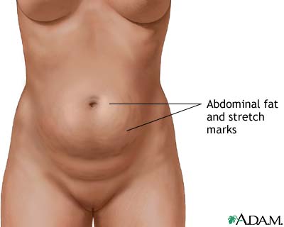 Abdominoplasty - series Abdominoplasty - series
