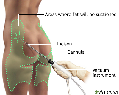 Procedure Procedure