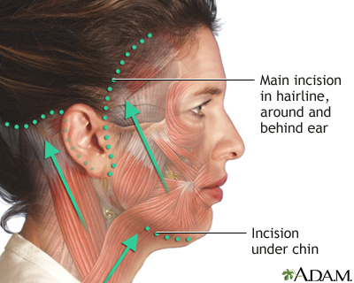 Incisions Incisions