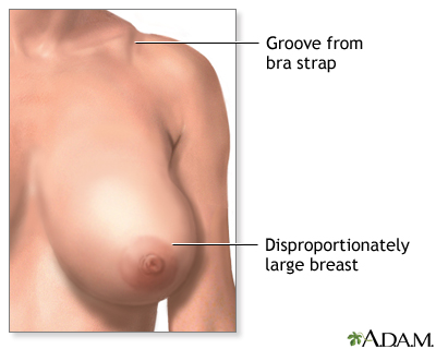 Breast reduction (mammoplasty) - series - Indications Breast reduction (mammoplasty) - series - Indications
