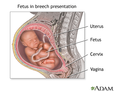 Breech presentation Breech presentation