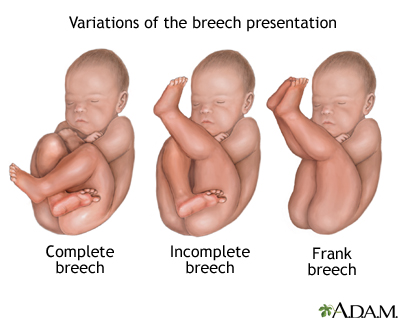 Types of breech presentation Types of breech presentation