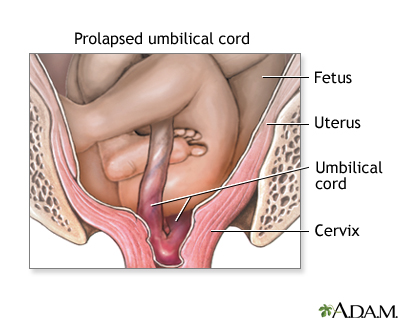Complications of breech Complications of breech