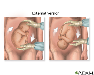 Correcting breech Correcting breech