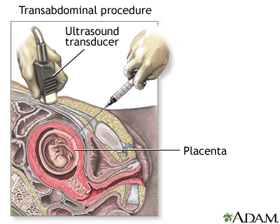 Procedure, part 2 - transabdominal Procedure, part 2 - transabdominal