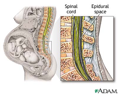Epidural - series Epidural - series