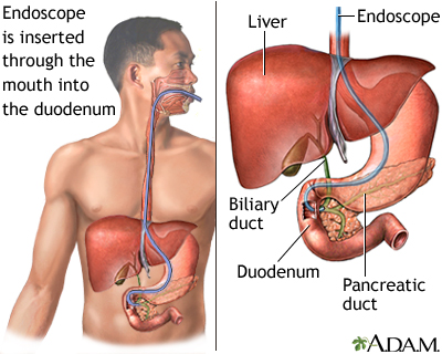 ERCP ERCP