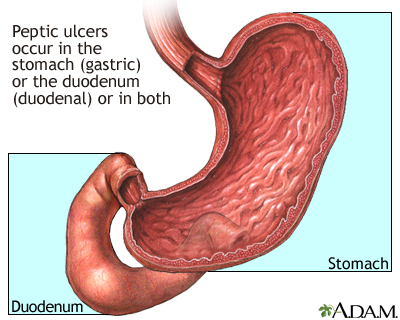 Location of peptic ulcers Location of peptic ulcers