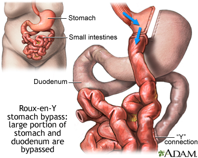 Roux-en-Y stomach surgery for weight loss Roux-en-Y stomach surgery for weight loss