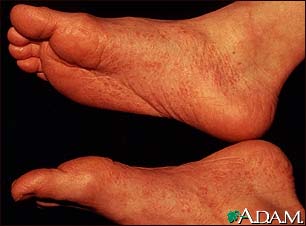 Reactive arthritis - view of the feet Reactive arthritis - view of the feet
