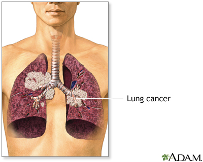Secondhand smoke and lung cancer Secondhand smoke and lung cancer