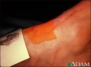 Sweat test