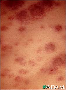Acute monocytic leukemia - skin