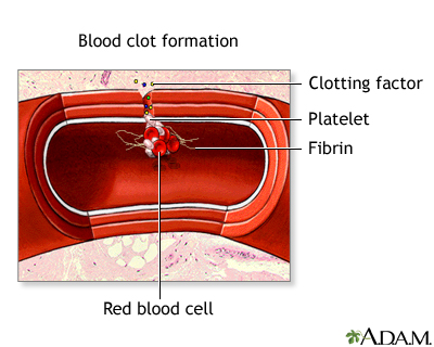 Blood clot formation Blood clot formation