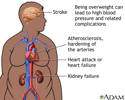 Obesity and health Obesity and health
