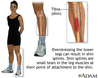 Shin splints Shin splints