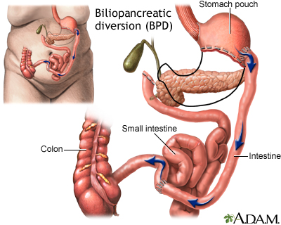 Biliopancreatic diversion (BPD) Biliopancreatic diversion (BPD)