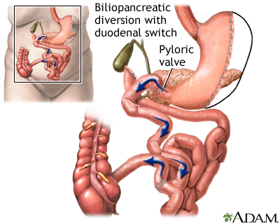 Biliopancreatic diversion with duodenal switch Biliopancreatic diversion with duodenal switch