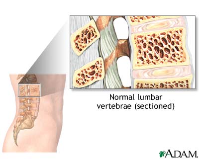 Vertebroplasty - series Vertebroplasty - series