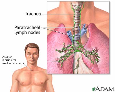 Mediastinoscopy Mediastinoscopy