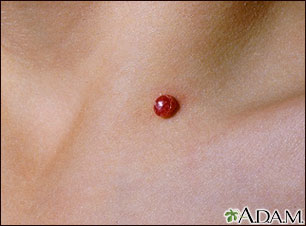 Pyogenic granuloma - close-up Pyogenic granuloma - close-up