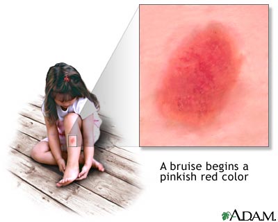 Bruise healing - series Bruise healing - series