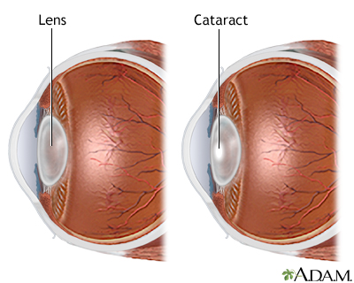 Cataract Cataract