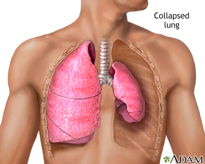 Collapsed lung, pneumothorax Collapsed lung, pneumothorax