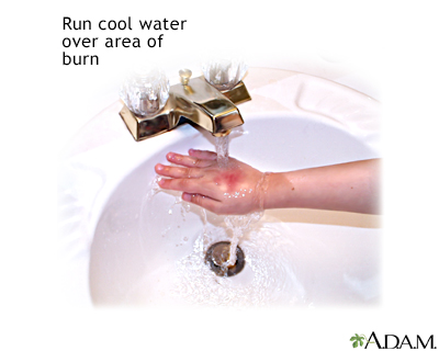 Minor burn treatment - run under cool water Minor burn treatment - run under cool water