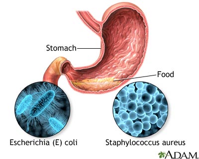 Food poisoning Food poisoning