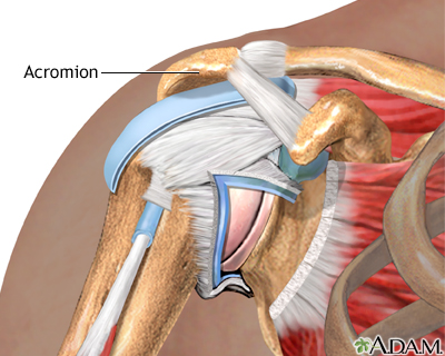 Impingement syndrome Impingement syndrome