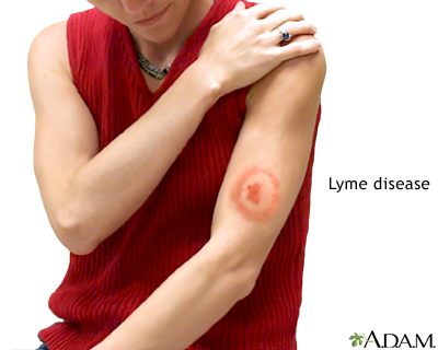 Lyme disease Lyme disease