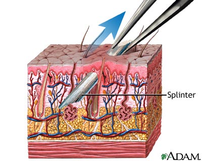 Splinter removal Splinter removal