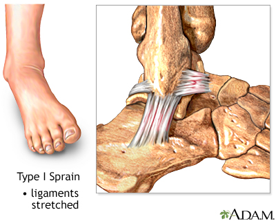 Type I ankle sprain Type I ankle sprain