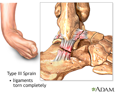 Type III ankle sprain Type III ankle sprain
