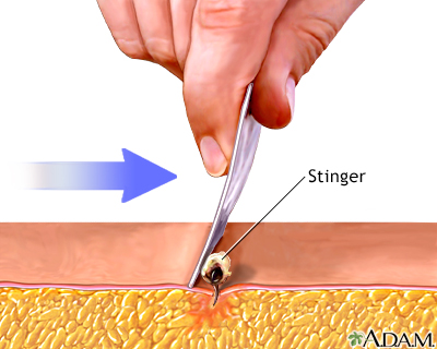 Stinger removal Stinger removal