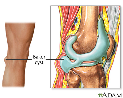 Baker cyst Baker cyst