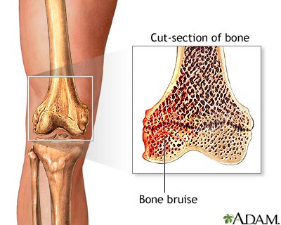 Bone bruise Bone bruise