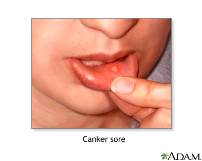 Canker sore Canker sore