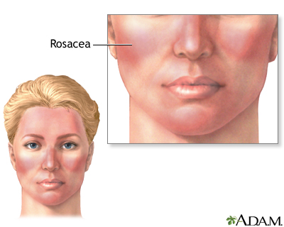 Rosacea Rosacea